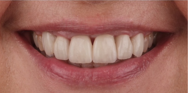 Caso clínico de cirugía periodontal y preservación de papila con cambio de carillas dentales