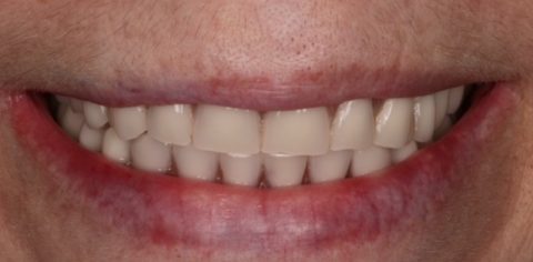 caso clinico implantes dentales y sobredentadura