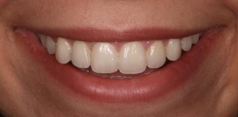 sustituir prótesis puente maryland por implanrte dental y corona de zirconio