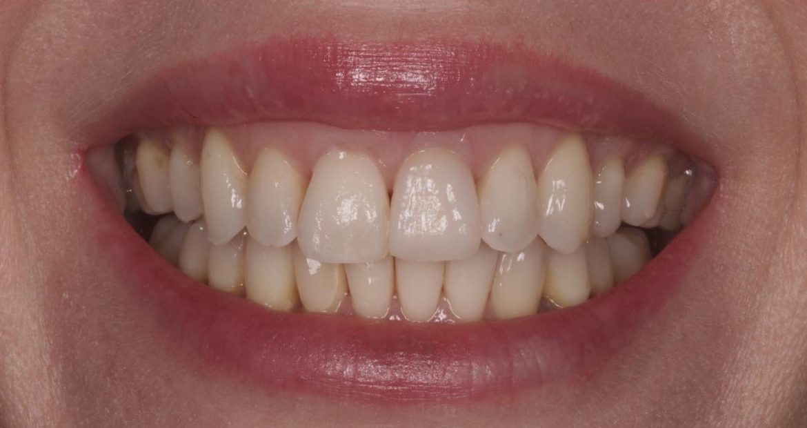 caso clínico recesión de encías y sustitución carillas dentales