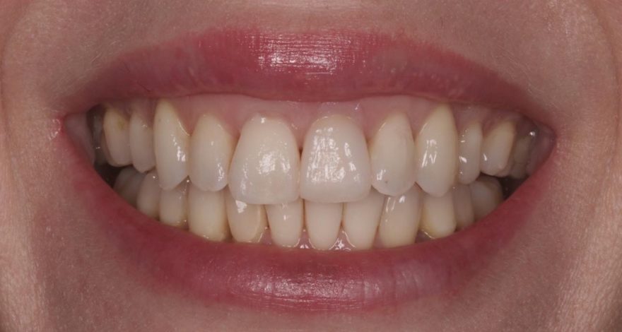 caso clínico recesión de encías y sustitución carillas dentales