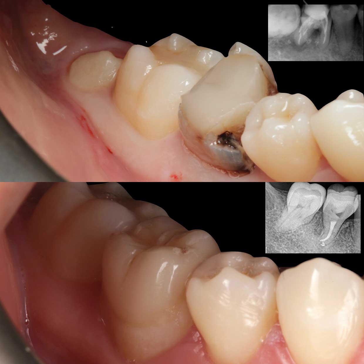 antes y despues autotrasplante dental