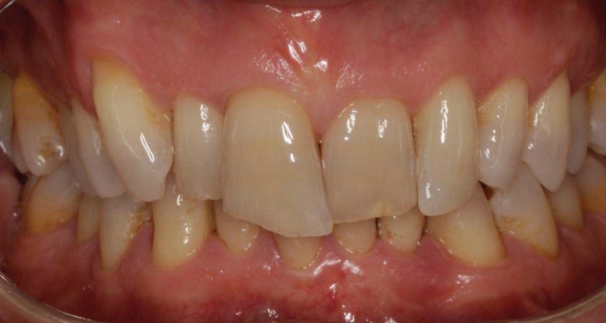 caso clínico de maloclusión tipo 2, sobremordida aumentada y apiñamiento dental
