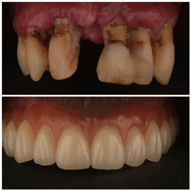 solución movilidad clase 3 piezas dentales antes y después